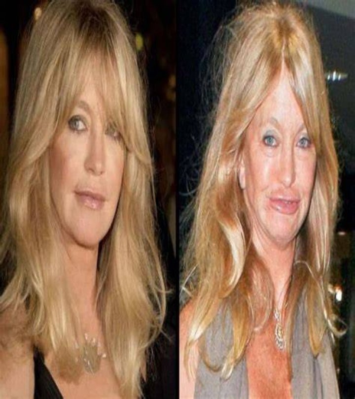 Celebrity Plastic Surgery Disasters Goldie Hawn Bogdanoff Brothers