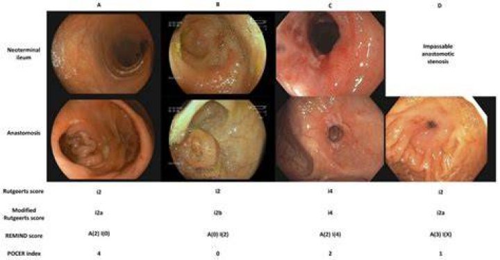 Colonoscopy showing (A) moderately erythematous mucosa in the sigmoid