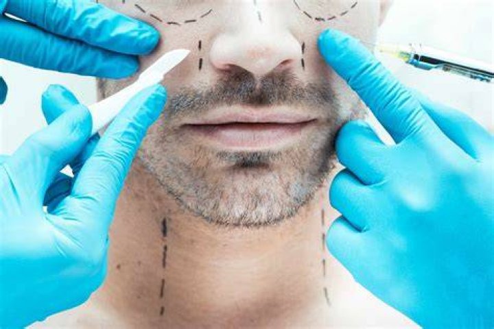 Plastic Surgery Turned Handsome French Twin Actors Into Freakish Cat People